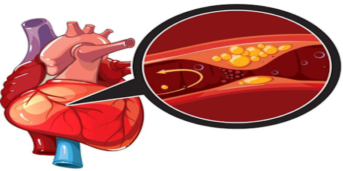 Coronary Artery Disease