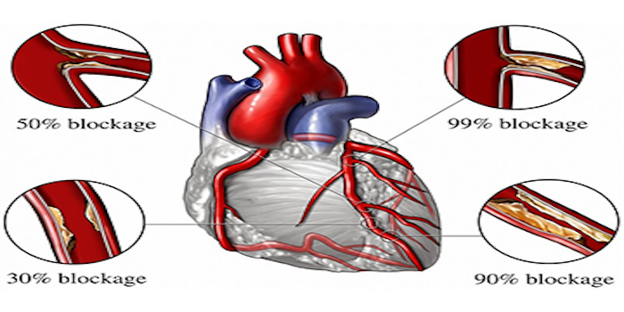Coronary Angiography