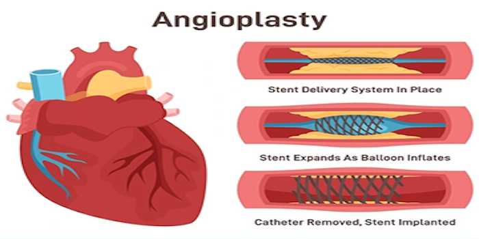 Coronary Angioplasty