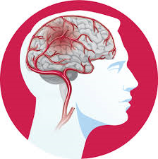 Stroke System Entry Criteria